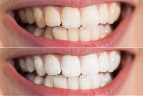 Sau 4 lần sử dụng, răng đã trắng sáng hơn nhiều